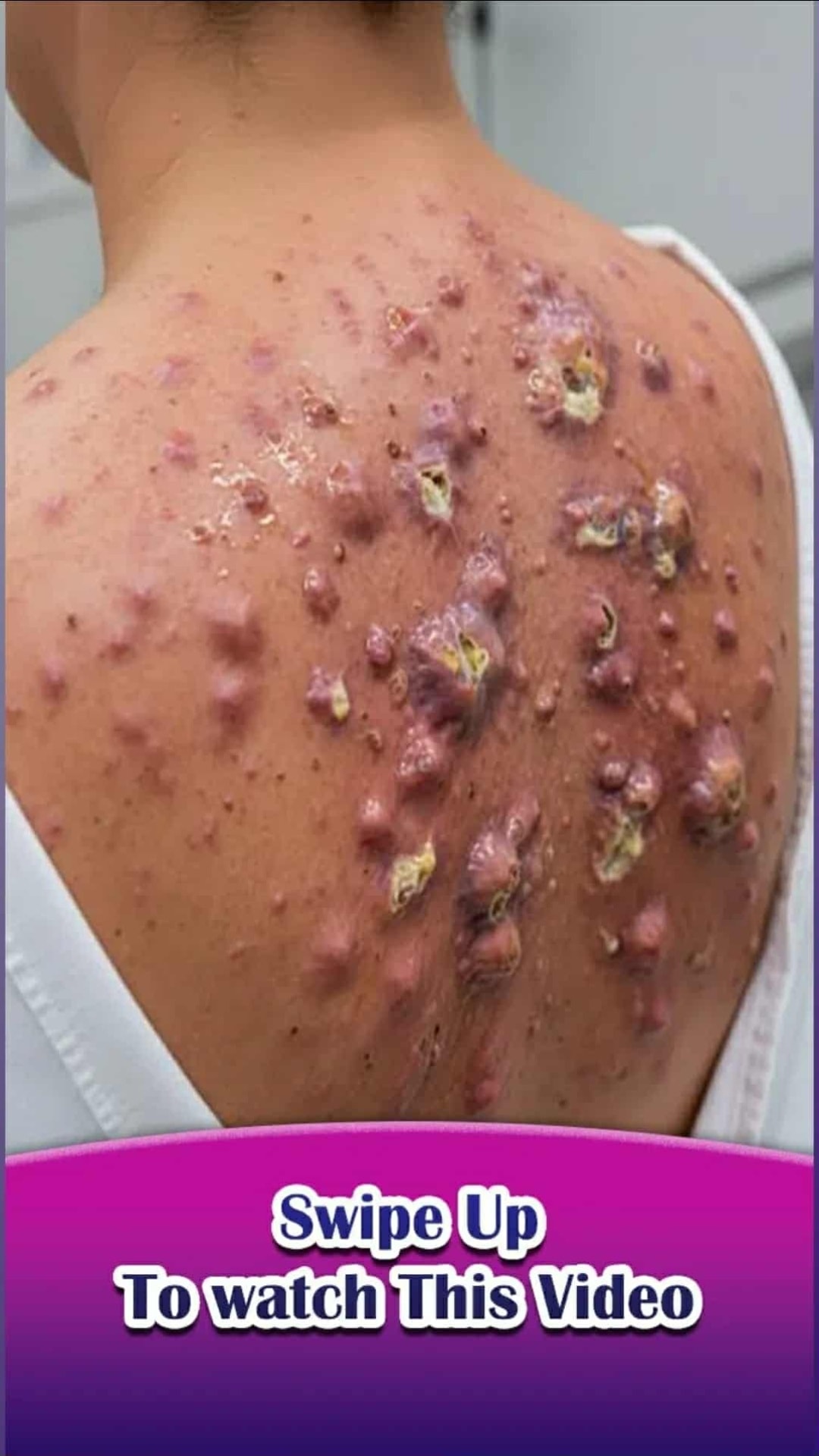 Severe Back Acne and Skin Infections: What You Need to Know