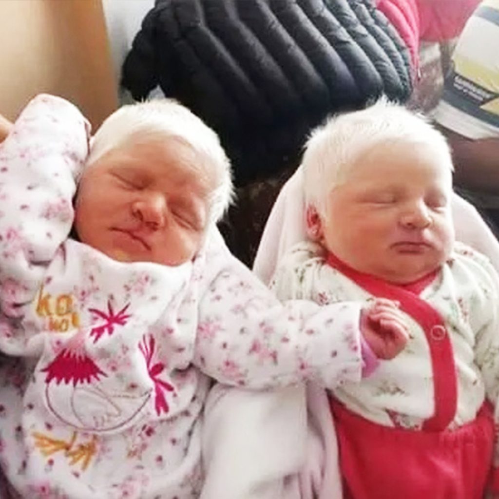 The First Ever Albino Twins Born in Argentina Stunned the World