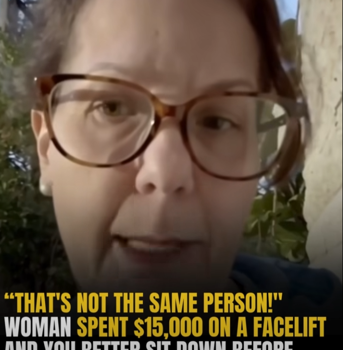 Woman’s $15,000 Facelift Goes Viral — Viewers Can’t Believe the Transformation