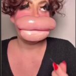 Lips Are Extremely Enlarged