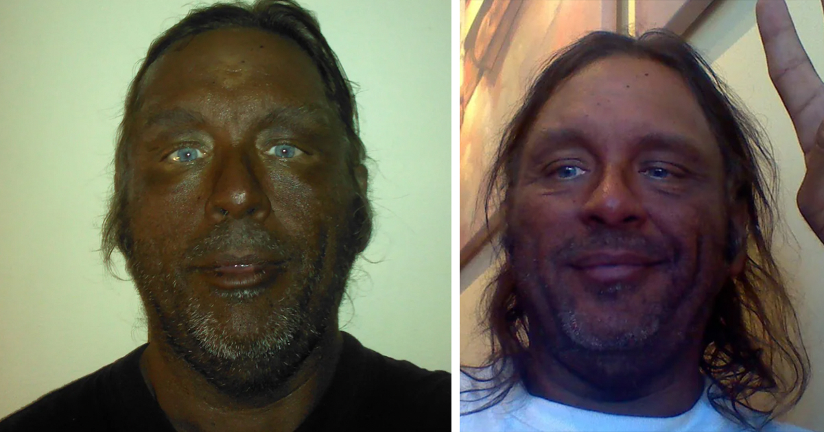 Long-Term User of Tanning Peptide Issues Stark Caution After Two Decades of Use