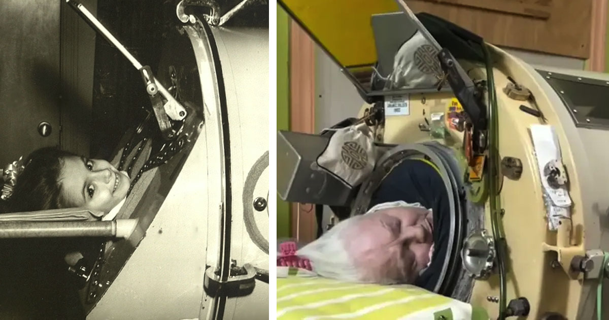 Final Chapter: The Last American Iron Lung Patient Passes Away at 78