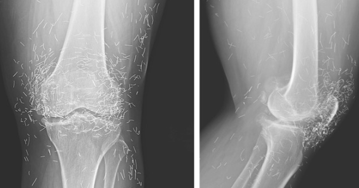 Doctors Astonished by Gold Needles Found in Woman's Knees During X-Ray
